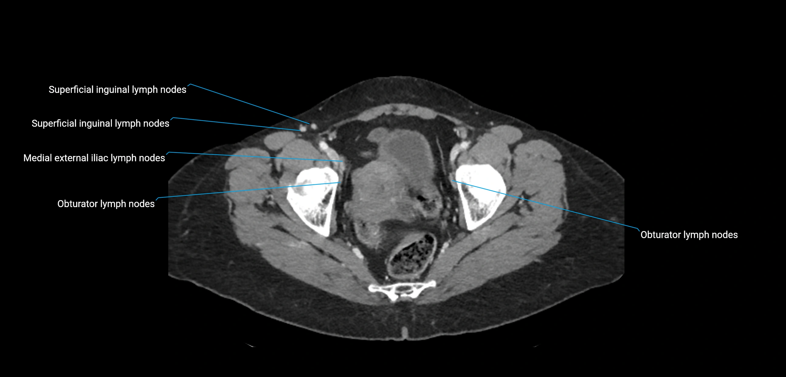 CT ct abdominal lymph nodes  axial cross sectional anatomy  enchanced radiology image -img-00002-00375.webp